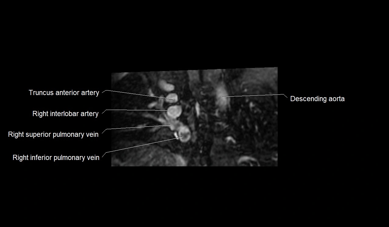 MRI heart and coronary arteries short axis anatomy image 1.webp